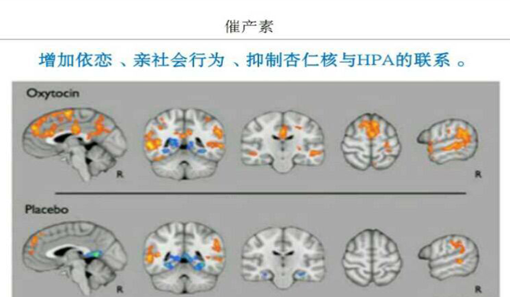 低频次催产素喷鼻结合正向社会互动可改善孤独症儿童症状