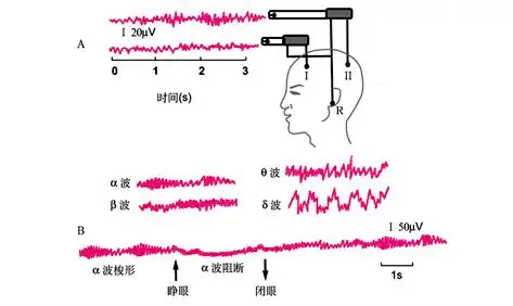 多动症儿童脑电图(EEG)异常的性质与临床意义