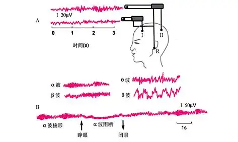 多动症儿童脑电图(EEG)异常的性质与临床意义 多动症儿童脑电图(EEG)异常的性质与临床意义