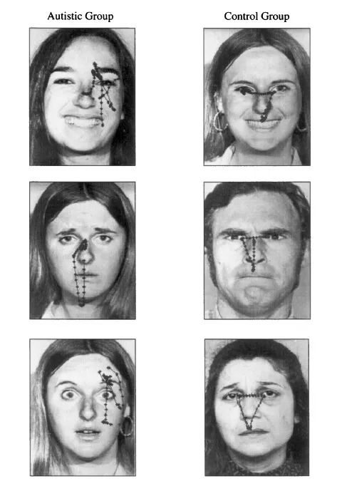 孤独症患者（左）和正常对照组（右）的眼动轨迹 
