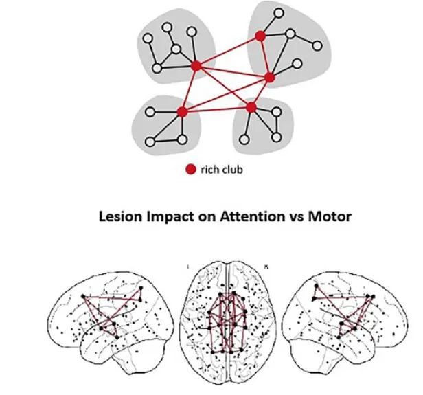 脑网络效率对中风后运动和注意缺陷的不同影响
